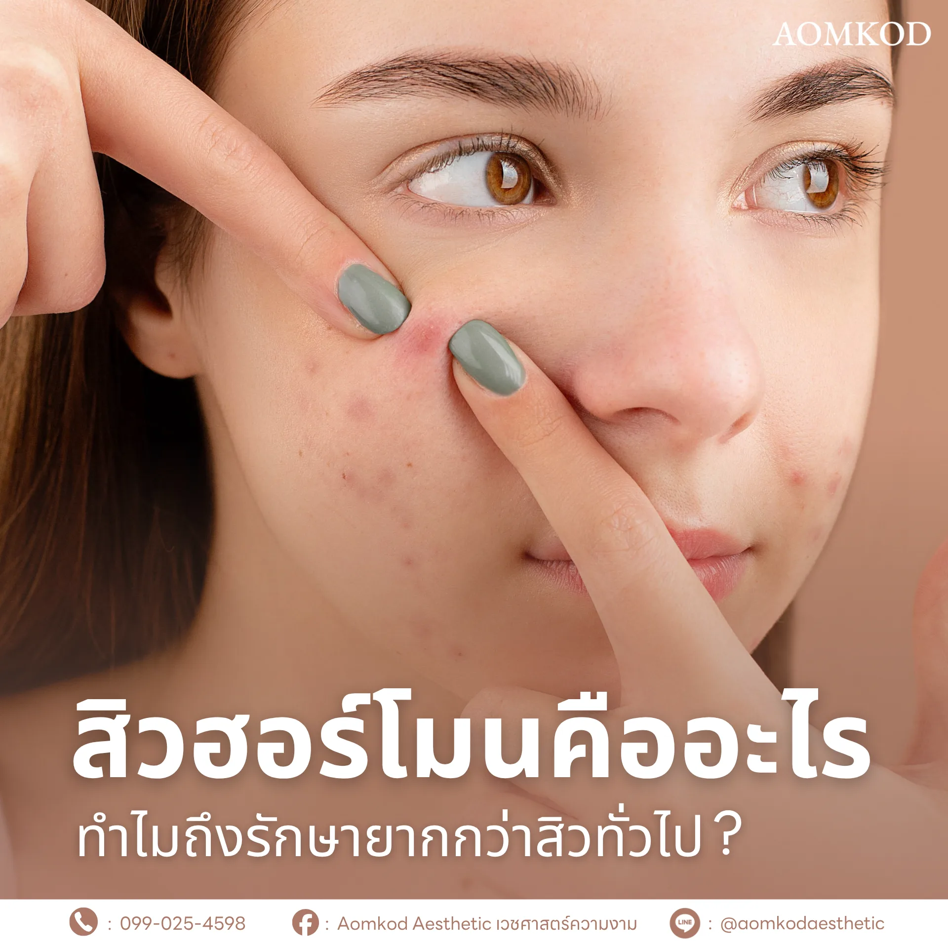 สิวฮอร์โมนคืออะไร ทำไมถึงรักษายากกว่าสิวทั่วไป?