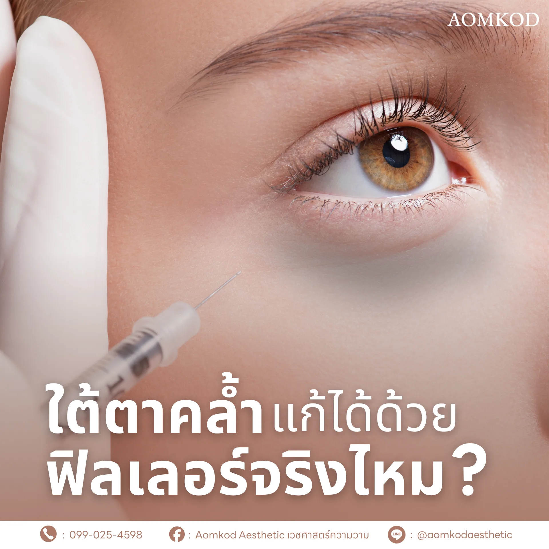 ใต้ตาคล้ำ แก้ได้ด้วยฟิลเลอร์จริงไหม?
