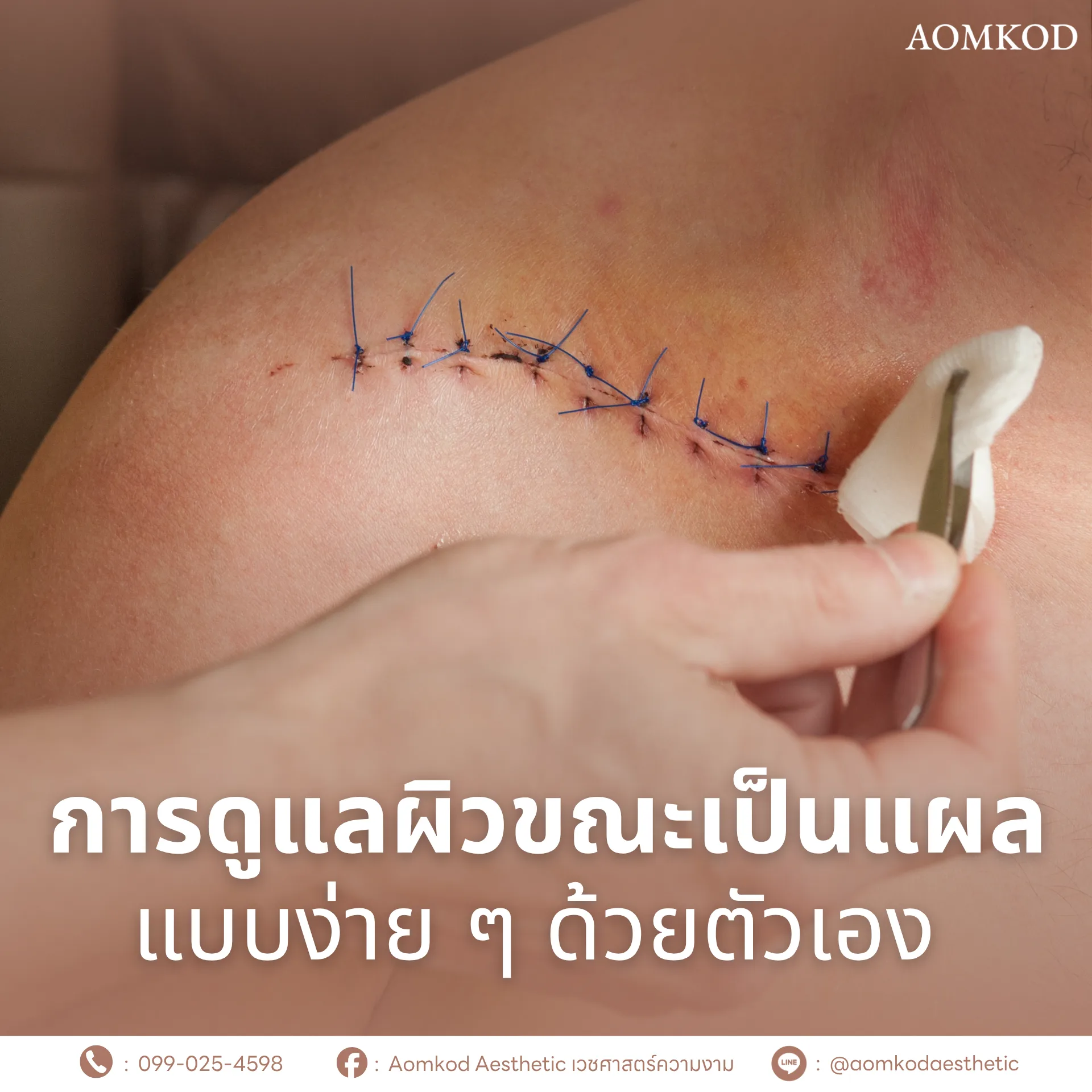 การดูแลผิวขณะเป็นแผล แบบง่าย ๆ ด้วยตัวเอง